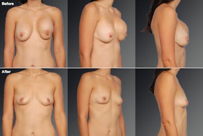 Breast Implant Revision Before & After Gallery - Patient 105656068 - Image 1