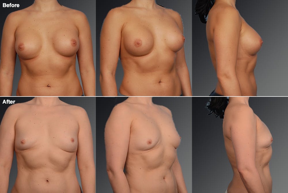 Breast Implant Revision Before & After Gallery - Patient 105656083 - Image 1