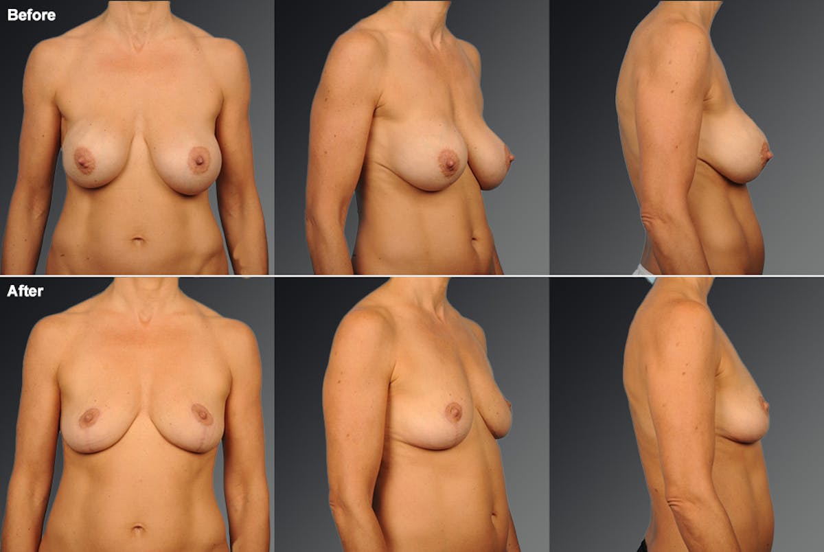 Breast Implant Revision Before & After Gallery - Patient 105656086 - Image 1