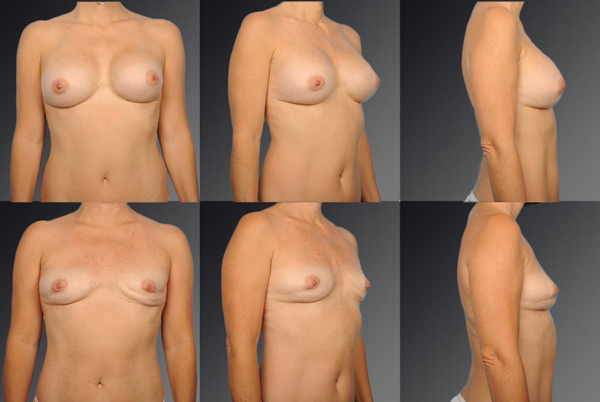 Breast Implant Revision Before & After Gallery - Patient 105656088 - Image 1
