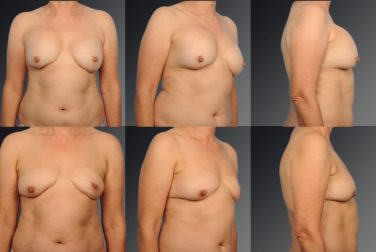 Breast Implant Revision Before & After Gallery - Patient 105656089 - Image 1
