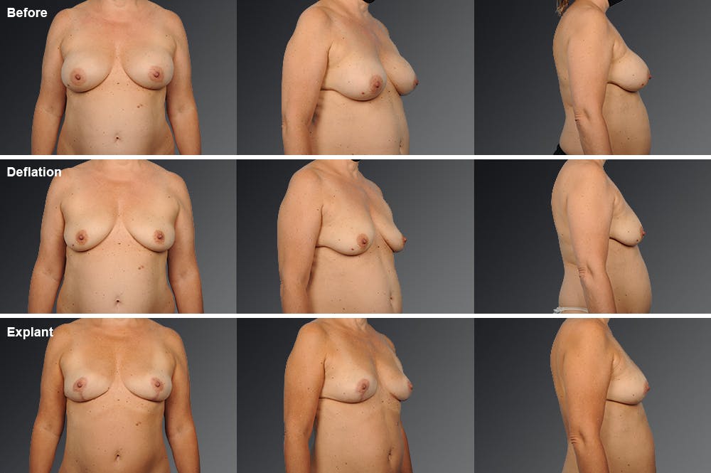 Breast Implant Revision Before & After Gallery - Patient 105656127 - Image 1