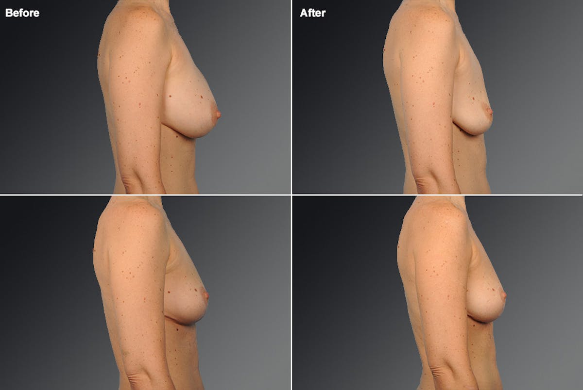 Breast Implant Revision Before & After Gallery - Patient 105656134 - Image 1