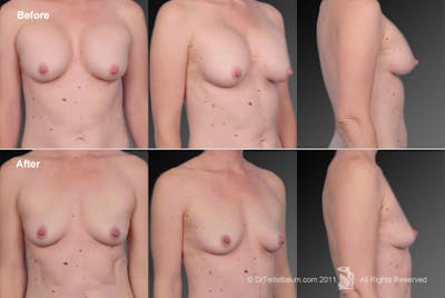 Breast Implant Revision Before & After Gallery - Patient 105656215 - Image 1