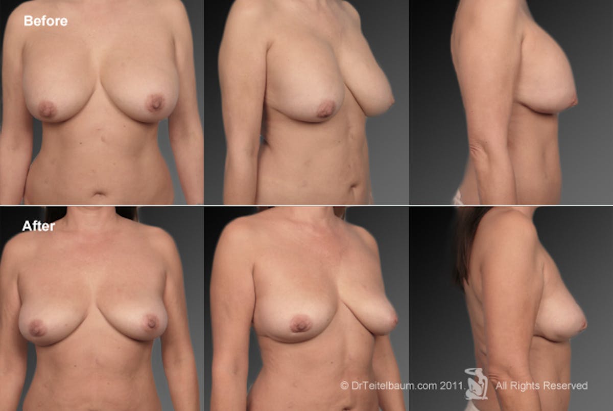 Breast Implant Revision Before & After Gallery - Patient 105656247 - Image 1