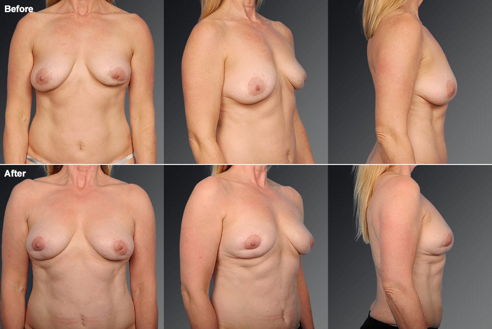 Breast Implant Revision Before & After Gallery - Patient 105656254 - Image 1
