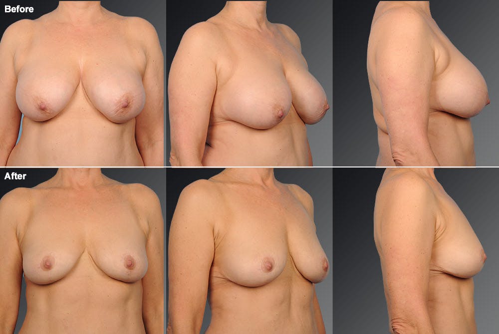 Breast Implant Revision Before & After Gallery - Patient 105656257 - Image 1