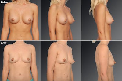 Breast Implant Revision Before & After Gallery - Patient 105656258 - Image 1