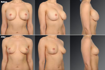 Breast Implant Revision Before & After Gallery - Patient 105656276 - Image 1