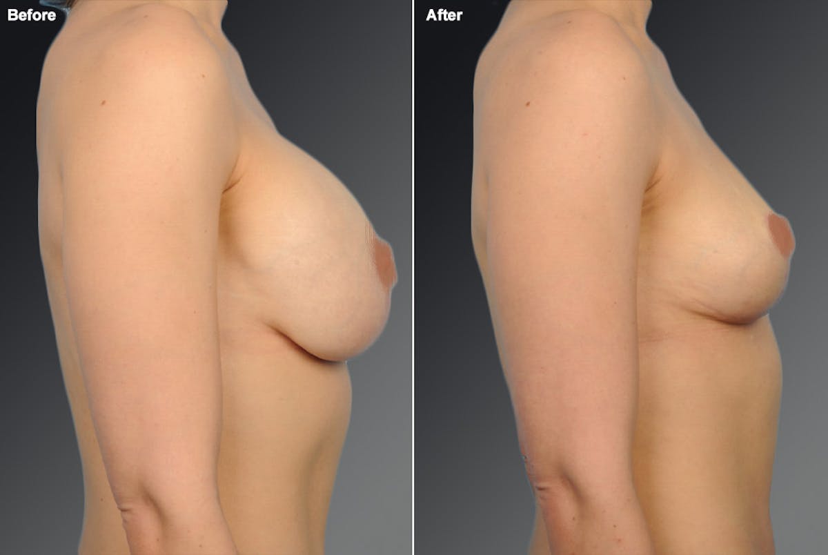 Breast Implant Revision Before & After Gallery - Patient 105656278 - Image 1
