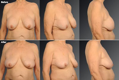 Breast Implant Revision Before & After Gallery - Patient 105656289 - Image 1
