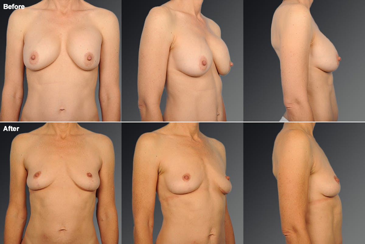 Breast Implant Revision Before & After Gallery - Patient 105656292 - Image 1