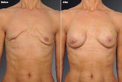 Breast Implant Revision Before & After Gallery - Patient 105666728 - Image 1