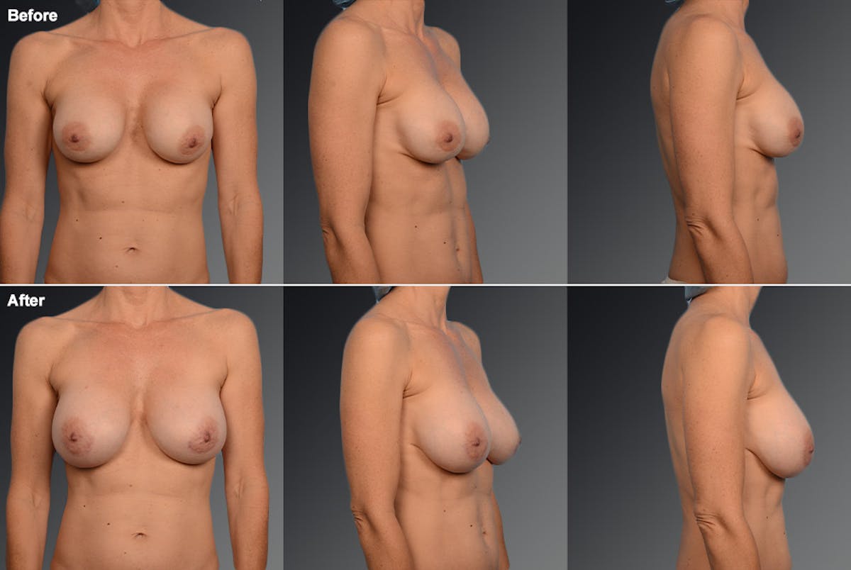 Breast Implant Revision Before & After Gallery - Patient 105666799 - Image 1