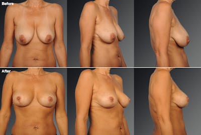 Breast Implant Revision Before & After Gallery - Patient 105666864 - Image 1