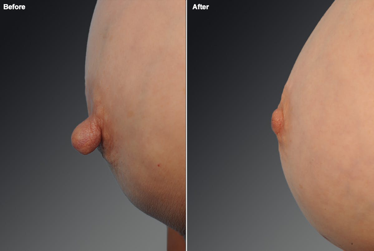 Nipple Reduction Before & After Gallery - Patient 105666943 - Image 1