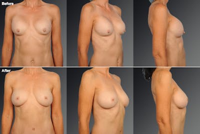 Nipple Reduction Before & After Gallery - Patient 105666944 - Image 1