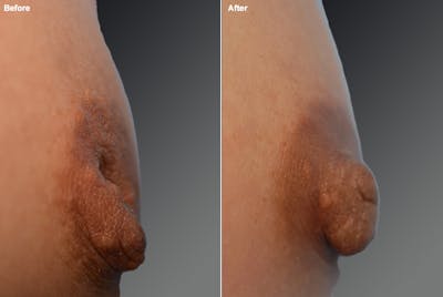 Inverted Nipple Before & After Gallery - Patient 119059862 - Image 1