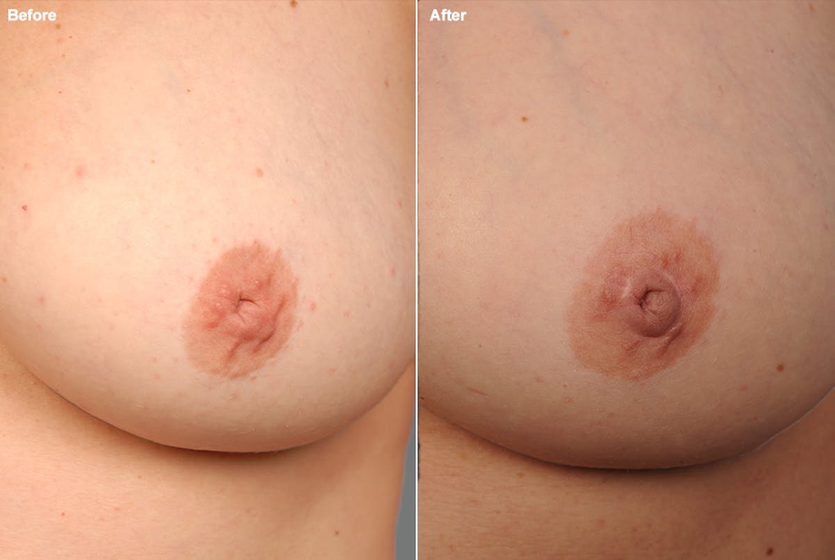 Inverted Nipple Before & After Gallery - Patient 119059864 - Image 1