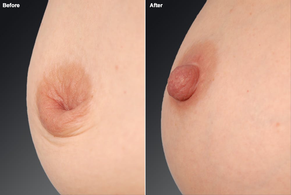 Inverted Nipple Before & After Gallery - Patient 119059865 - Image 1