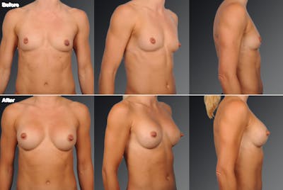 Inverted Nipple Before & After Gallery - Patient 119059866 - Image 1