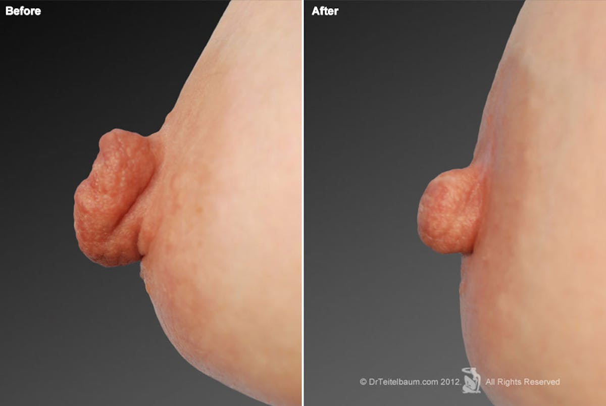 Nipple Reduction Before & After Gallery - Patient 105666962 - Image 1