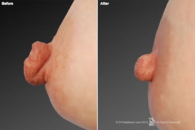 Nipple Reduction Before & After Gallery - Patient 105666962 - Image 1