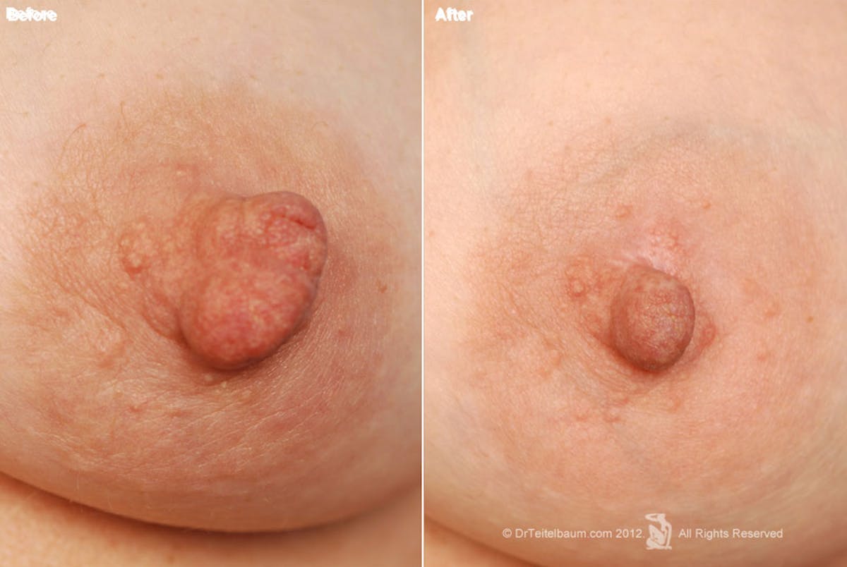 Nipple Reduction Before & After Gallery - Patient 105666964 - Image 1