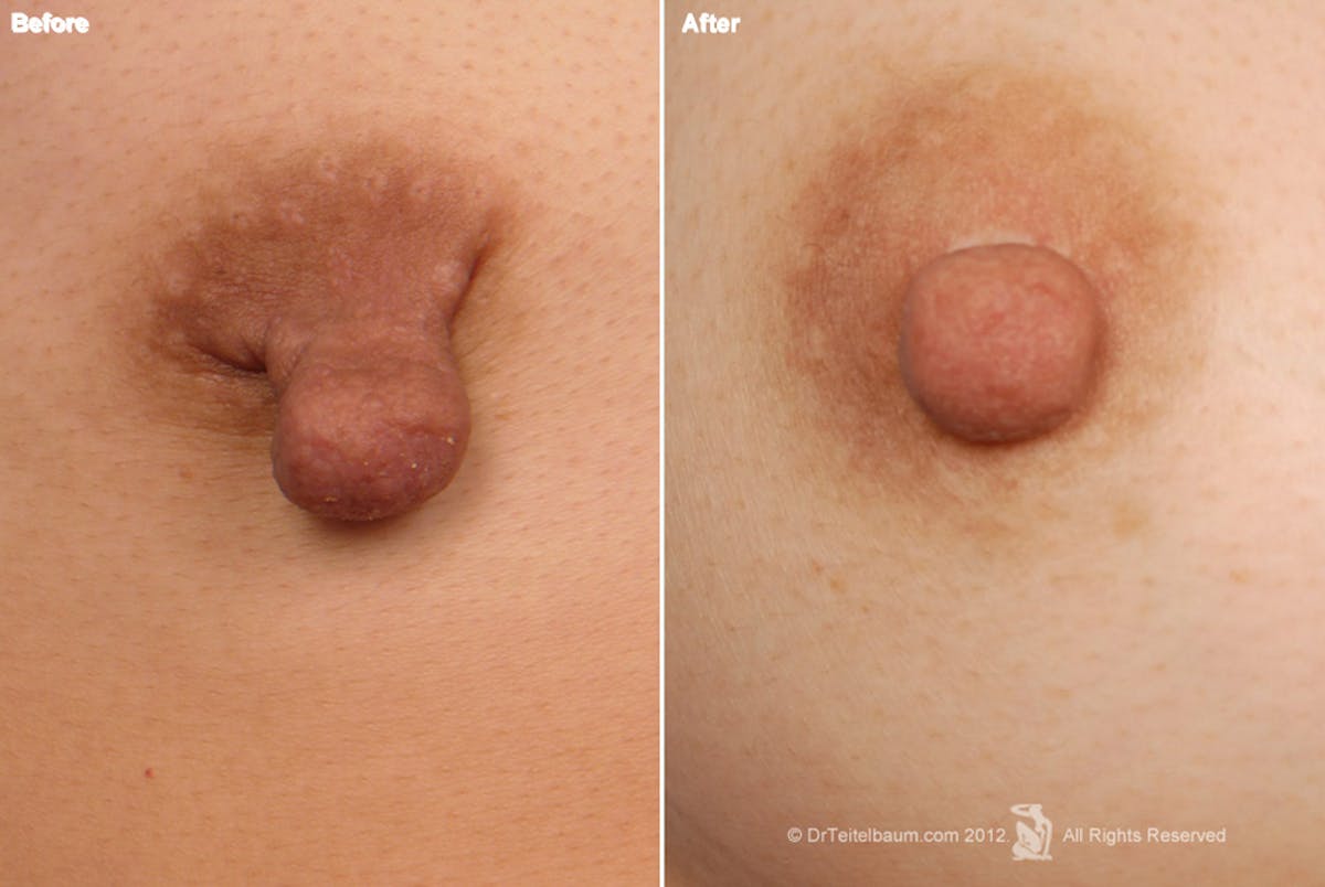 Nipple Reduction Before & After Gallery - Patient 105666965 - Image 1