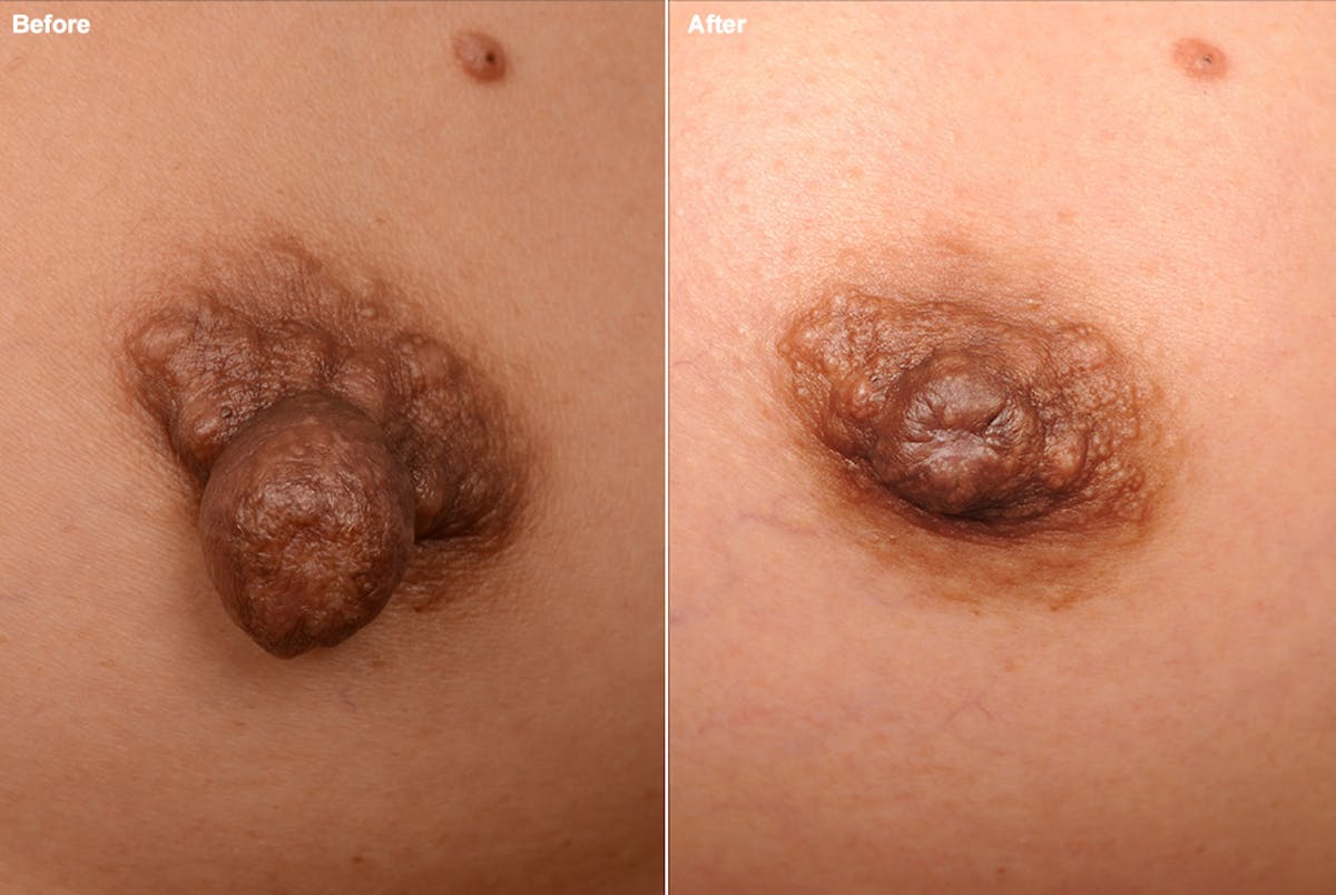 Nipple Reduction Before & After Gallery - Patient 105666966 - Image 1
