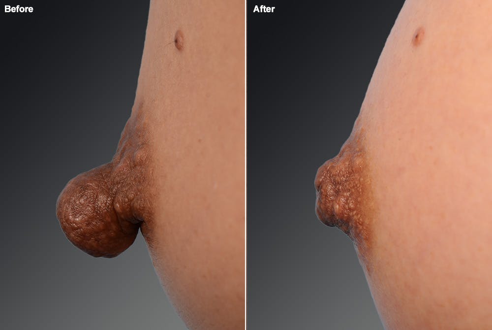 Nipple Reduction Before & After Gallery - Patient 105666968 - Image 1