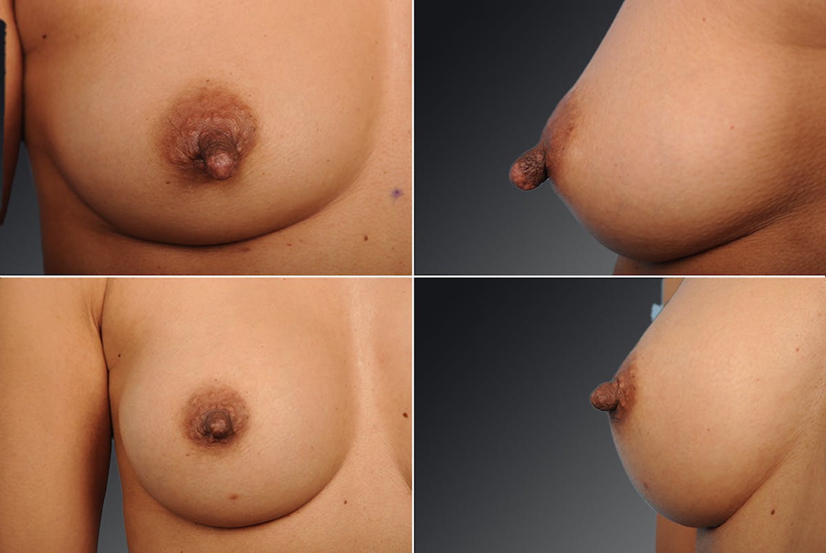 Nipple Reduction Before & After Gallery - Patient 105666974 - Image 1