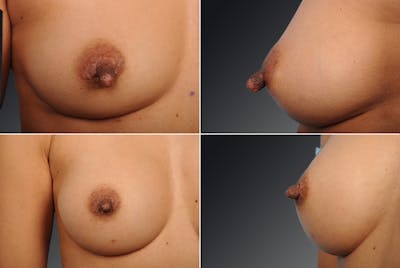 Nipple Reduction Before & After Gallery - Patient 105666974 - Image 1