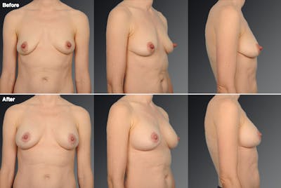 Nipple Reduction Before & After Gallery - Patient 105666975 - Image 1