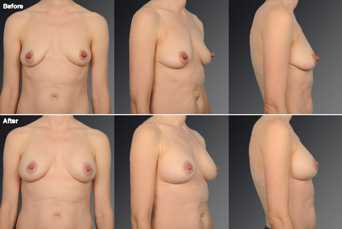 Nipple Reduction Before & After Gallery - Patient 105666975 - Image 1
