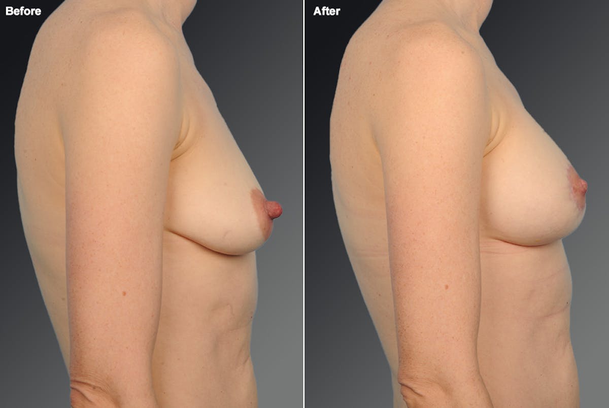 Nipple Reduction Before & After Gallery - Patient 105666976 - Image 1
