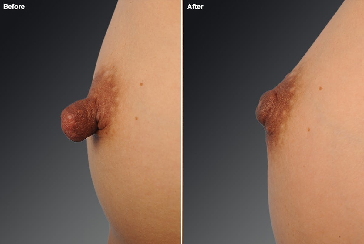 Nipple Reduction Before & After Gallery - Patient 105666977 - Image 1