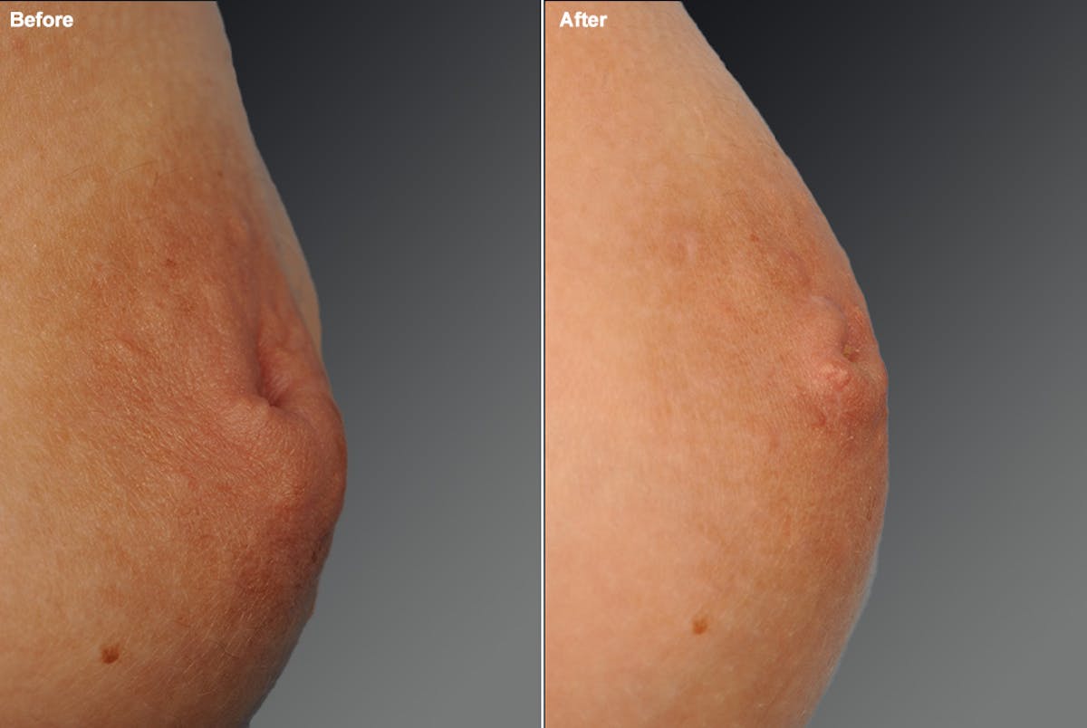 Inverted Nipple Before & After Gallery - Patient 119059878 - Image 1