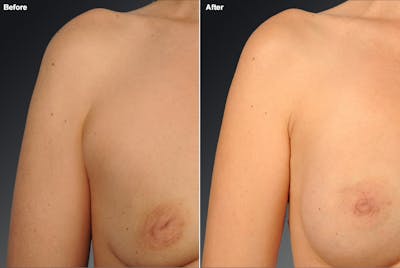 Inverted Nipple Before & After Gallery - Patient 119059879 - Image 1