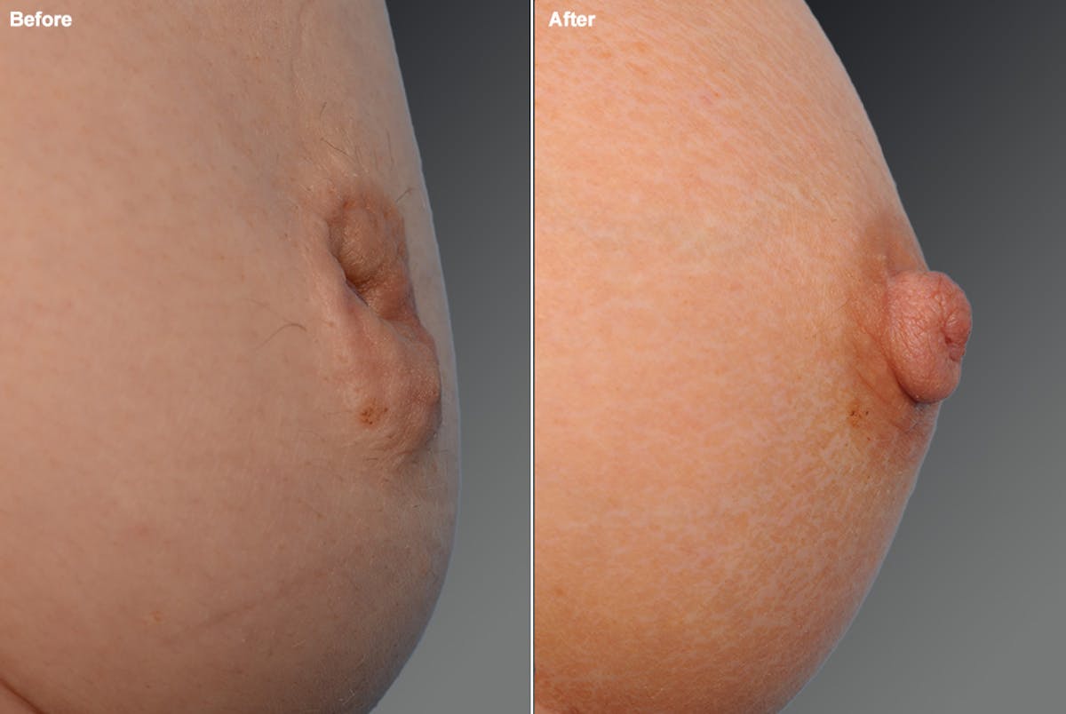 Inverted Nipple Before & After Gallery - Patient 119059880 - Image 1