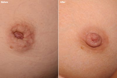 Inverted Nipple Before & After Gallery - Patient 119059881 - Image 1