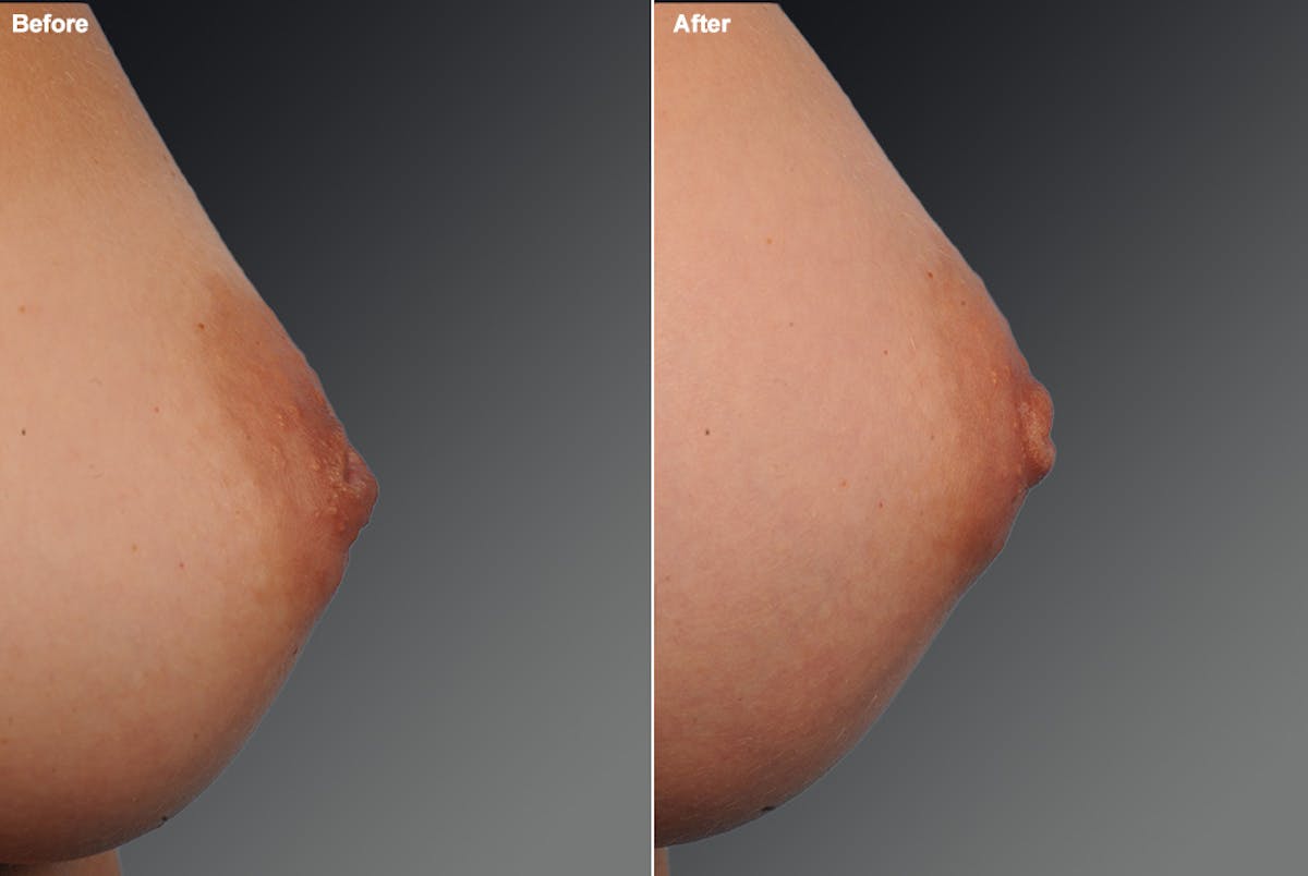 Inverted Nipple Before & After Gallery - Patient 119059882 - Image 1