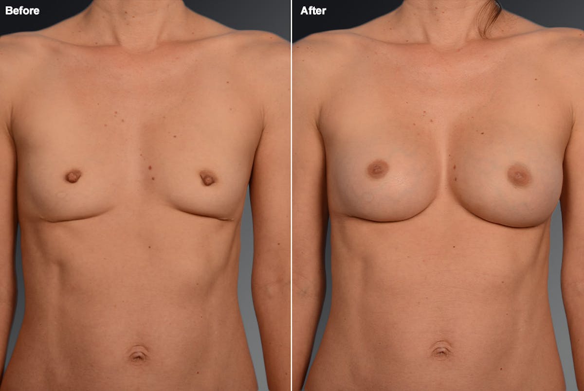 Nipple Reduction Before & After Gallery - Patient 105667048 - Image 1