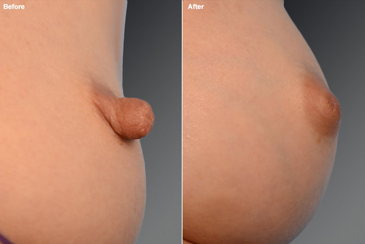 Nipple Reduction Before & After Gallery - Patient 105667052 - Image 1