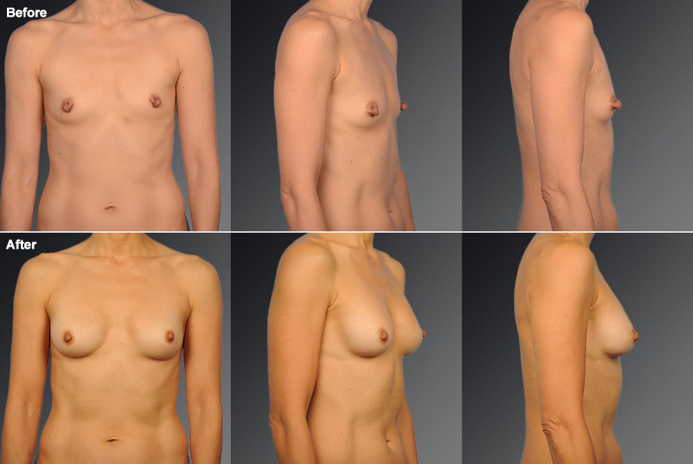Nipple Reduction Before & After Gallery - Patient 105667054 - Image 1
