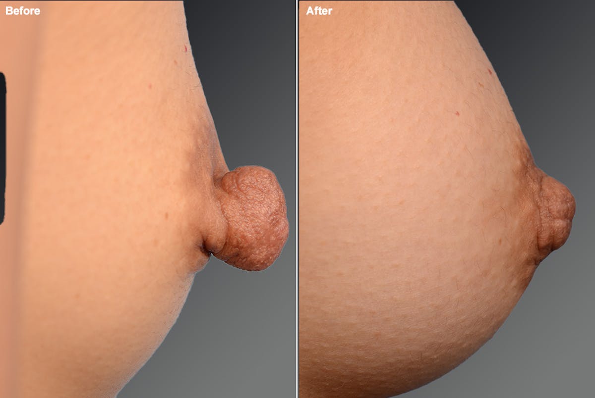 Nipple Reduction Before & After Gallery - Patient 105667055 - Image 1