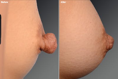 Nipple Reduction Before & After Gallery - Patient 105667055 - Image 1