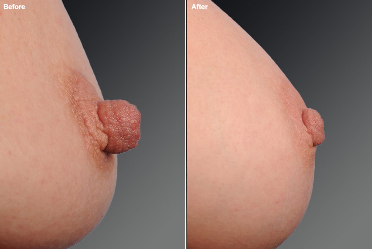 Nipple Reduction Before & After Gallery - Patient 105667056 - Image 1
