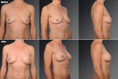 Nipple Reduction Before & After Gallery - Patient 105667063 - Image 1