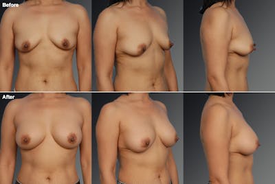 Nipple Reduction Before & After Gallery - Patient 105667064 - Image 1